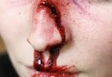 Ze złamanym nosem wrócił z boiska