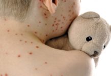 Środki ostrożności w głogowskim żłobku ze względu na podejrzenie zachorowania na odrę